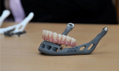 Напечатанная на 3D-принтере челюсть пересажена пожилой женщине (видео)